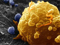 Célula cancerígena de las que forman el melanoma