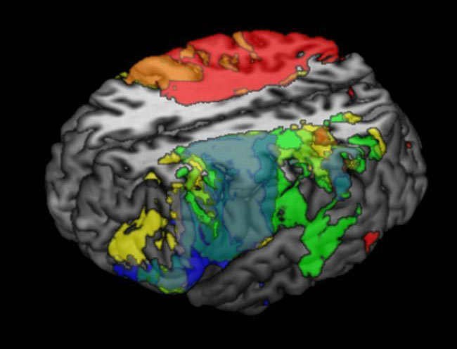 Mapa cerebral avanzado. Se realizaron escáneres cerebrales a 241 personas con algún déficit cognitivo. Todas estas imágenes fueron después relacionadas con las puntuaciones de dichas personas en el test de inteligencia WAIS. Así, pudieron relacionarse diversas partes del cerebro con las puntuaciones obtenidas en diferentes indicadores de inteligencia, como la capacidad lingüística o la memoria de trabajo
