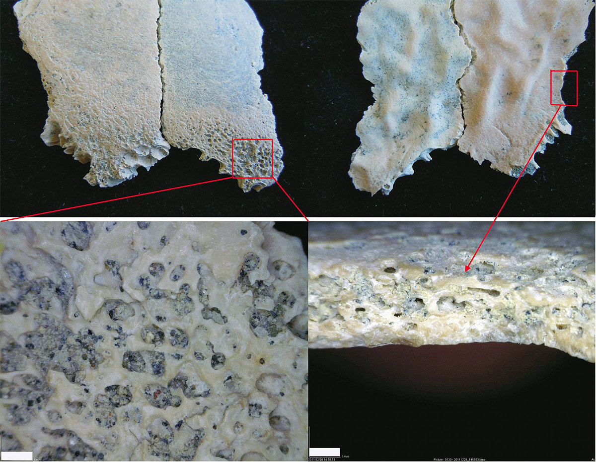 Fragmentos del parietal del niÃ±o de Olduvai. Abajo, las lesiones interpretadas como anemia