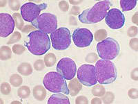 Células de leucemia linfoblástica
