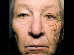 Dermatoheliosis unilateral. Foto: Jennifer R.S. Gordon, M.D. y Joaquin C. Brieva, M.D.