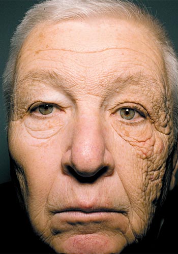Dermatoheliosis unilateral, daÃ±os por la radiaciÃ³n ultravioleta sobre la piel