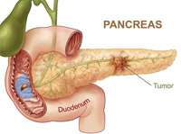 Cáncer de páncreas