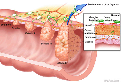 Estadios de avance del cáncer de colon