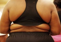 Obesidad mórbida. Foto: F. O'Reilly